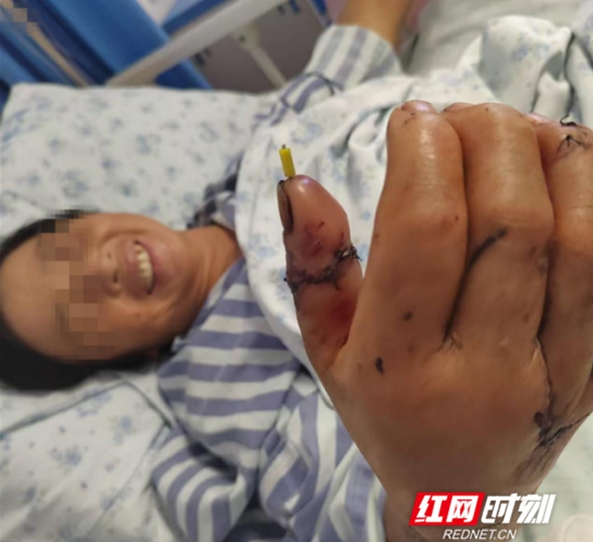 永州职院附属医院成功完成高难度断指再植手术